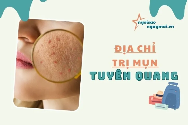 Top 8 địa chỉ trị mụn Tuyên Quang hiệu quả và uy tín nhất 2025