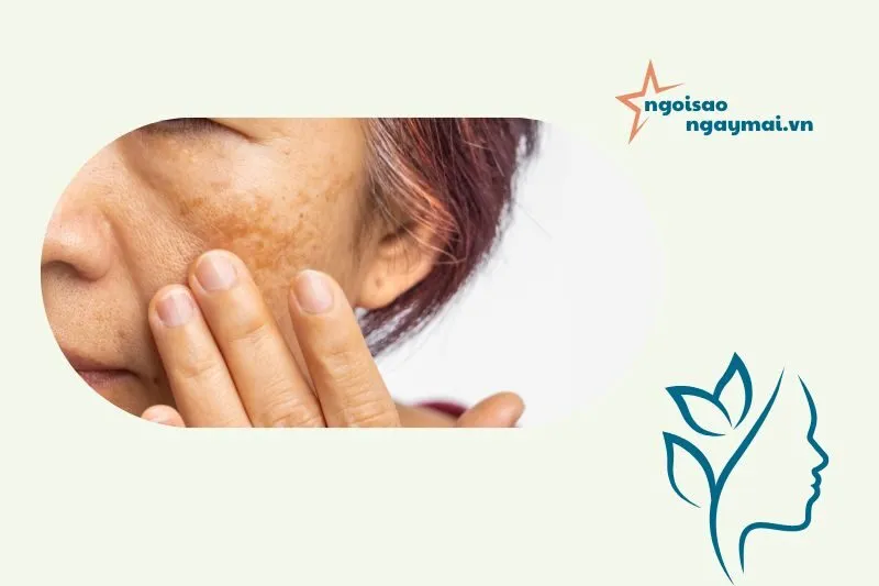 Danh Sách Spa Trị Nám Uy Tín Tại Tuyên Quang